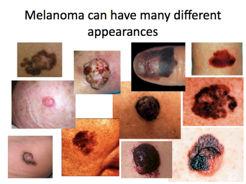 melanomasimptoms